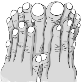 Clubbing, or enlargement of the ends of fingers (or sometimes the toes) due to a buildup of tissue