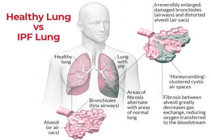 Healthy Lung VS Lung with Pulmonary Fibrosis