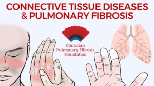 Connective Tissue Disease symptoms displayed with a set of scarred lungs